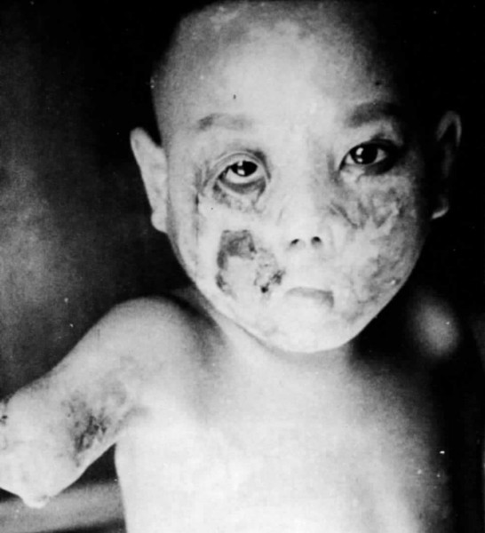 Hypertrophic scars and keloids on a napalm-bombed child. I don't know who this is of — I suspect it is from the Vietnam War. It is from SIPRI's Incidenary Weapons (1975), chapter 3, "Thermal effects of incendiary weapons on the human body," without a source listed. It puts a "human face" on these weapons, though, like no other photograph I've seen.