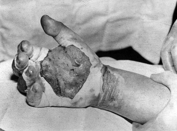 Harry K. Daghlian's blistered and burnt hand after he received his fatal radiation dose from his own dragon-tickling experiment gone wrong. 