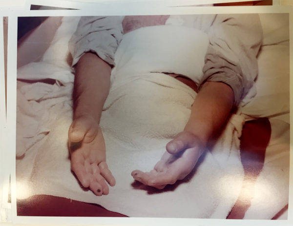 The hands of Louis Slotin, shortly after admission to the Los Alamos hospital. Source: Los Alamos National Laboratory, via the New York Public Library (Paul Mullin papers on the Louis Slotin Sonata).